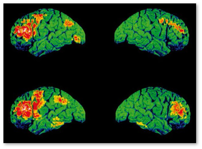 Schizofrenia-tomography