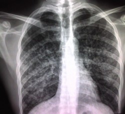 An-x-ray-of-lungs-showing-the-cloudy-mottled-appearance-that-is-characteristic-of-tuberculosis--Sandra-Bermudez-250x228