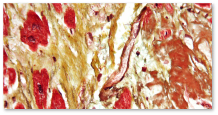 marijuana-heart-disease