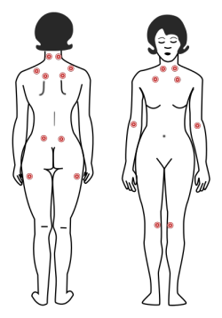 fibromialgiya-i-mialgicheskaya-ehncefalopatiya