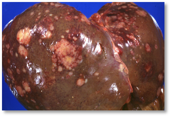 Human liver with metastatic lesions from primary pancreas carcinoma