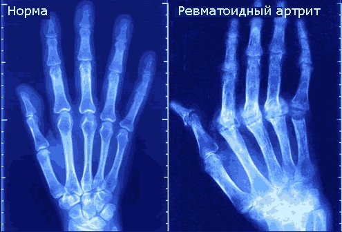 Rheumatoid-Arthritis-xray-01