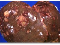 Компонет марихуаны защищает печень от последствий пьянства