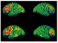 Исследование: Употребление марихуаны не усугубляет шизофрению