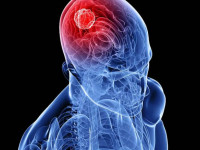 Компонент марихуаны КБД подавляет разрастание и распространение опухоли мозга