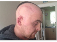 Северная Ирландия: Масло каннабиса остановило рост опухоли у пациента с раком мозга